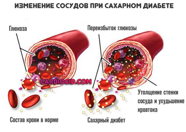 sosudy-pri-diabete.jpg