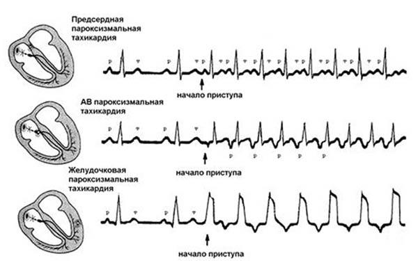 preparatyi-ot-serdechnoy-aritmii-i-tahikardii-1.jpg